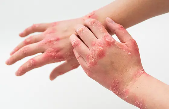 XEMSIS | psoriasis hand | psoriasis cream for hand skin