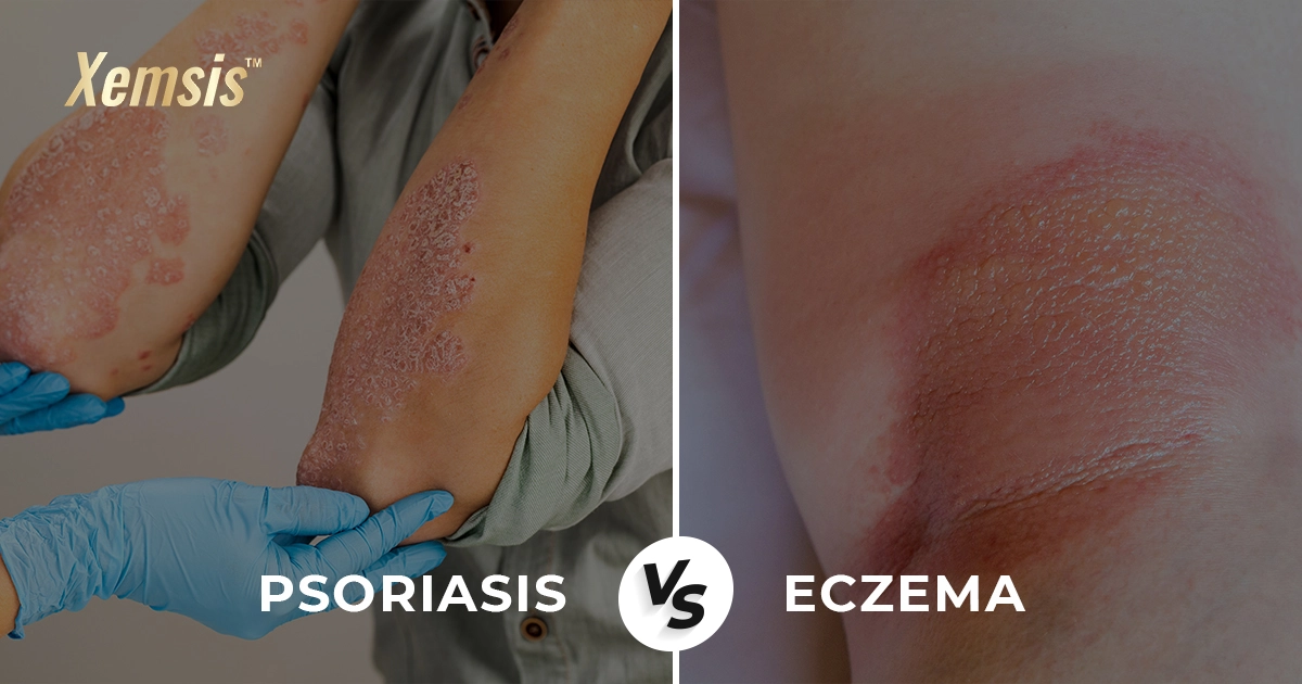 psoriasis vs eczema
