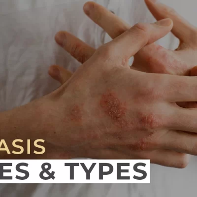 Understanding Psoriasis and its Types