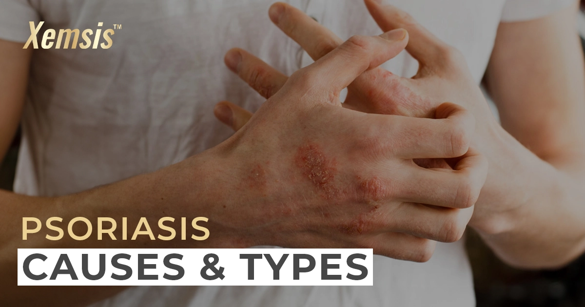 Understanding Psoriasis and its Types