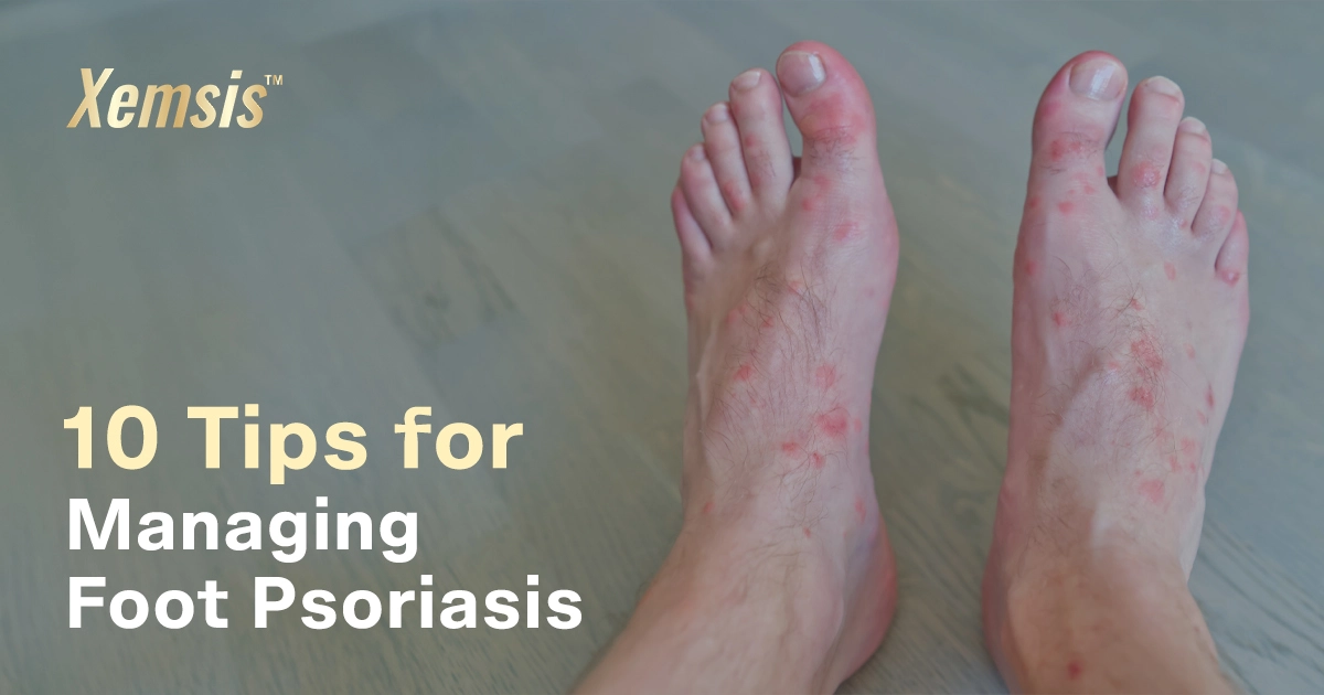 Tips for Managing Foot Psoriasis