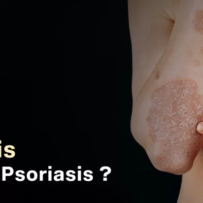 plaque psoriasis
