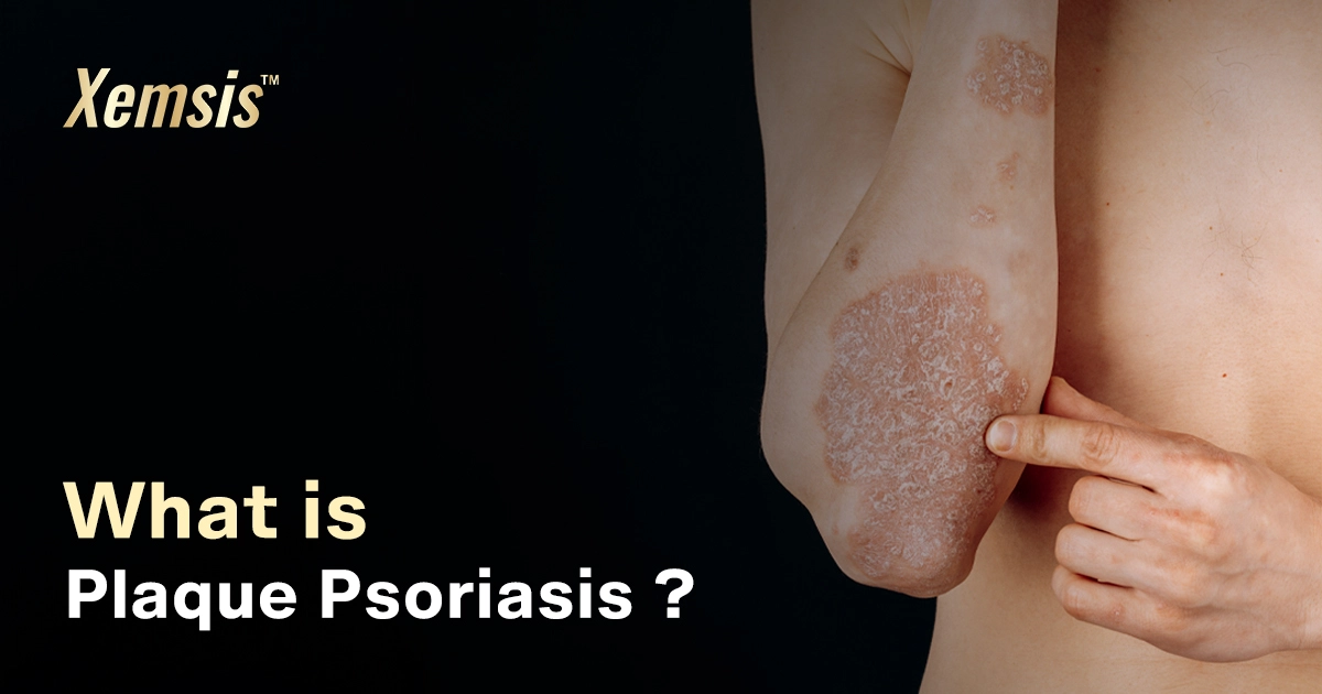 plaque psoriasis