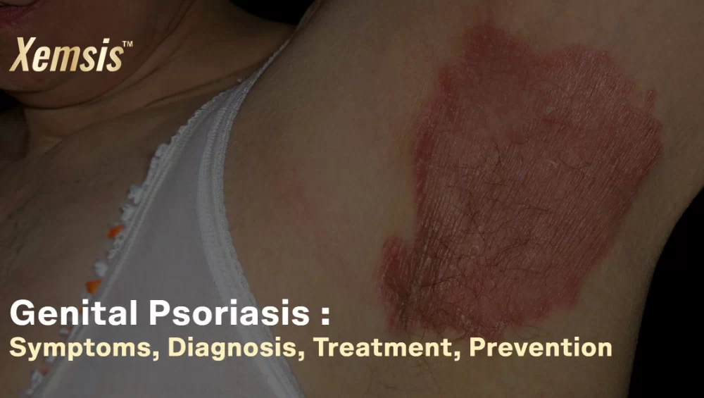 Genital psoriasis