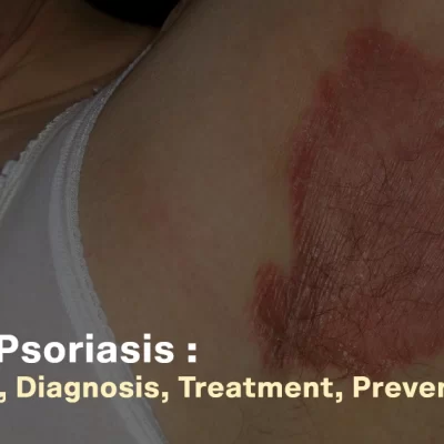 Genital psoriasis