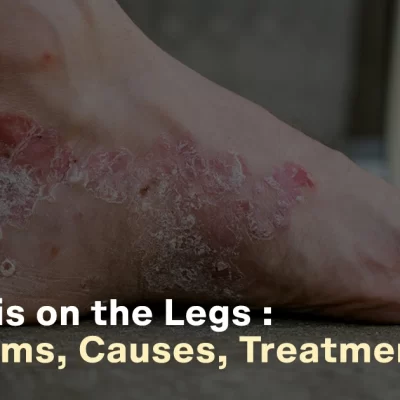 Psoriasis on the Legs