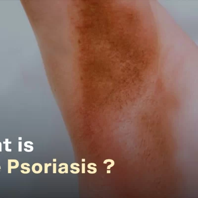 Inverse Psoriasis