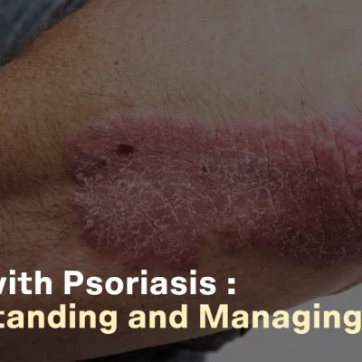 Living With Psoriasis