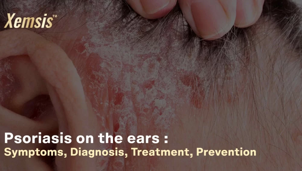Psoriasis in the ears
