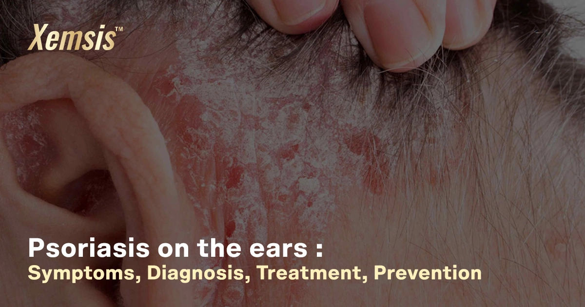 Psoriasis in the ears