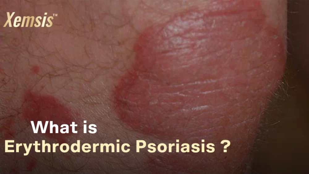 Erythrodermic Psoriasis