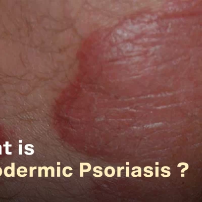 Erythrodermic Psoriasis