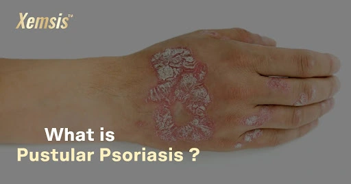 Pustular Psoriasis
