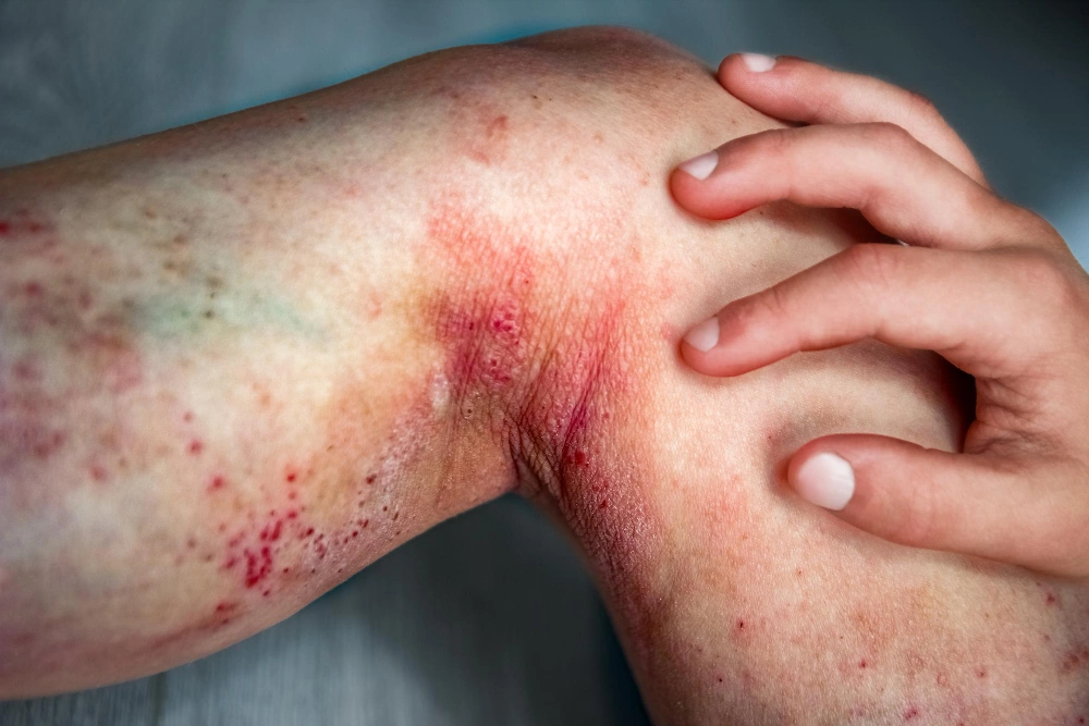 Inverse Psoriasis