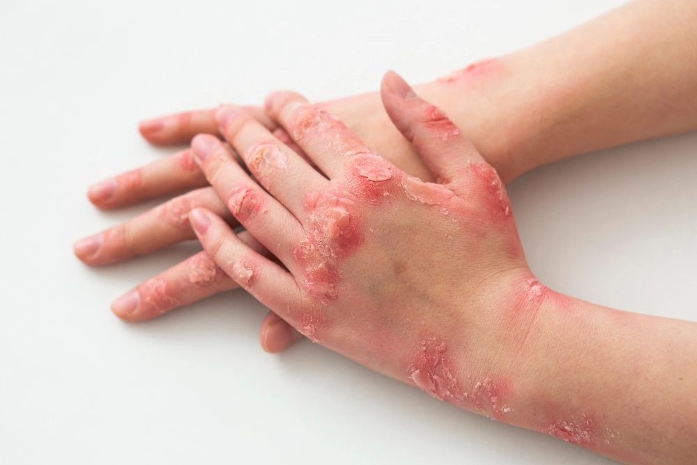Plaque Psoriasis