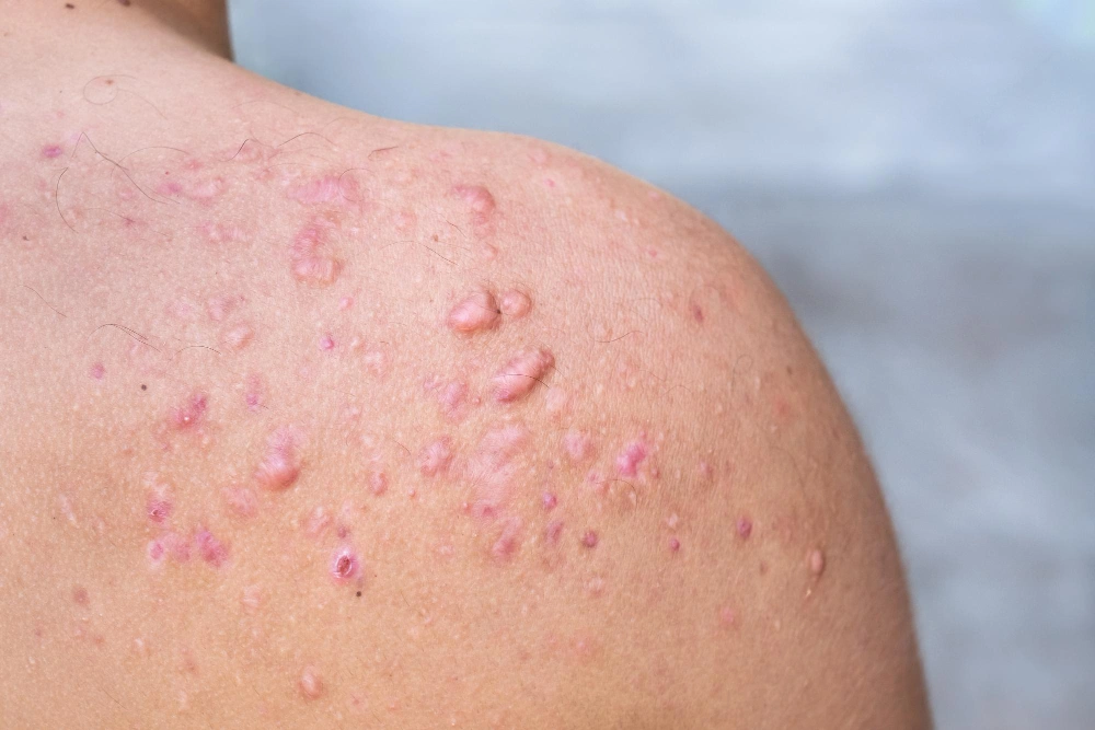 Pustular Psoriasis